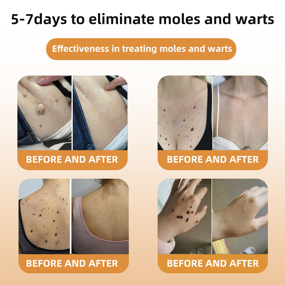 🎄 Holiday Sale Extravaganza: Enjoy 50% Off! ✨Honeybee Venom Mole and Wart Cream