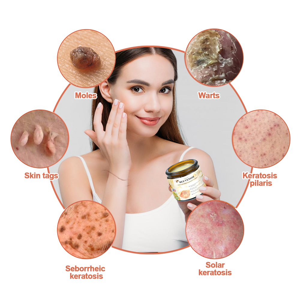 🎄 Holiday Sale Extravaganza: Enjoy 50% Off! ✨Honeybee Venom Mole and Wart Cream