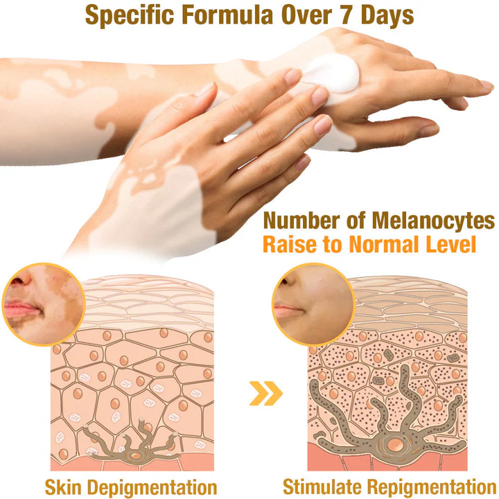 Seurico™ Bee Venom Vitiligo Treatment Cream