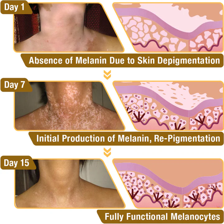 Seurico™ Bee Venom Vitiligo Treatment Cream