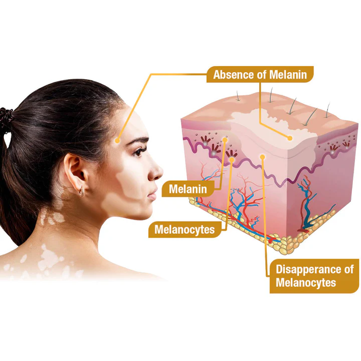 Seurico™ Bee Venom Vitiligo Treatment Cream