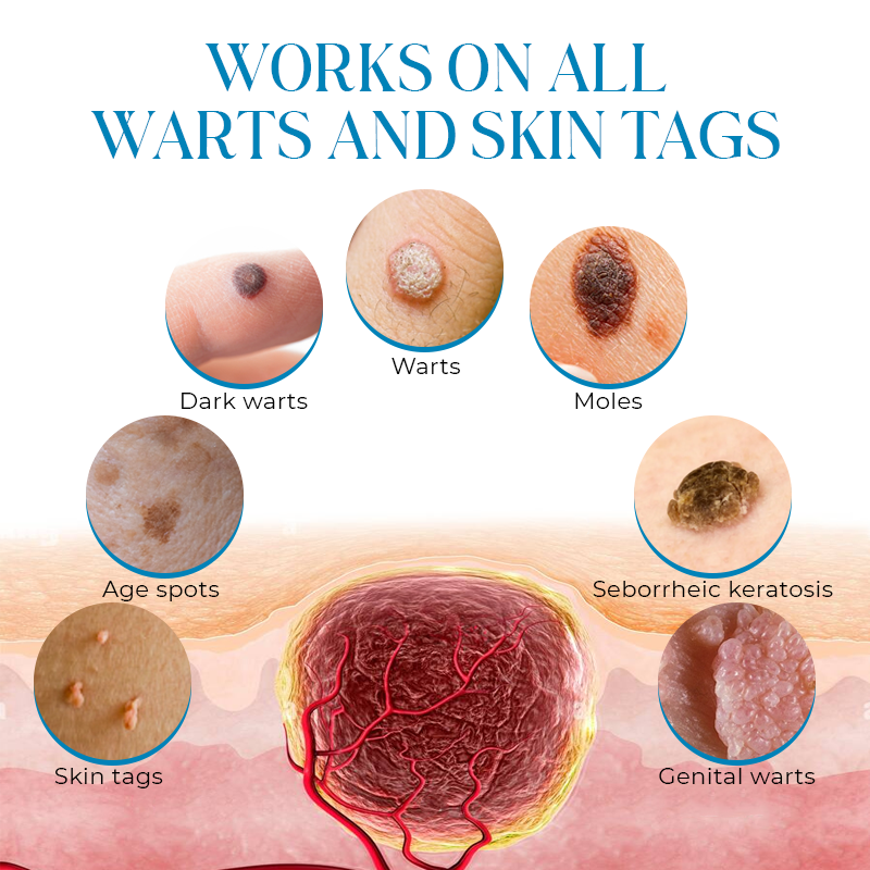 Seurico PapiClear Skin Tag & Wart Cream
