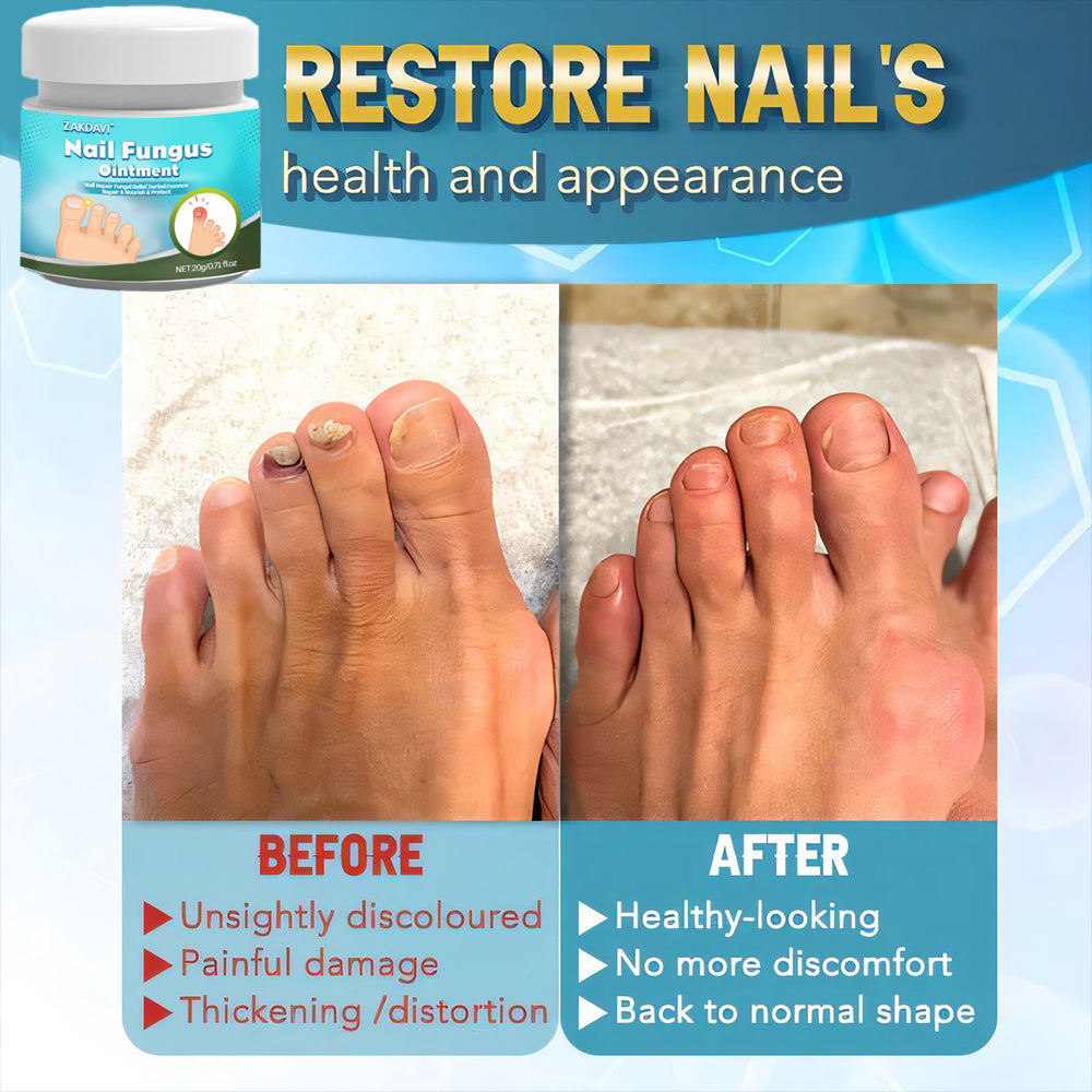 5X Quick-healing Nail Fungus Ointment