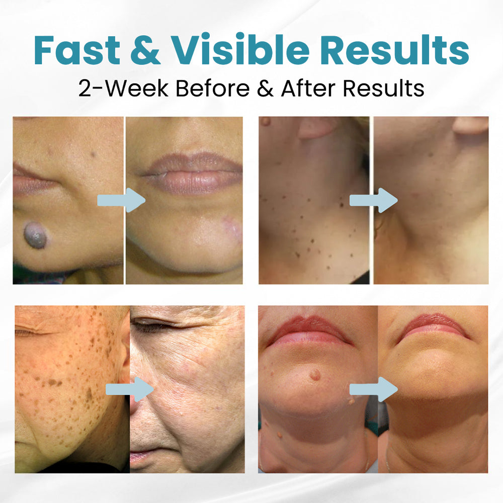 Seurico™ Laser Pen – Non-Invasive Mole and Wart Removal 1–3 days – gentle