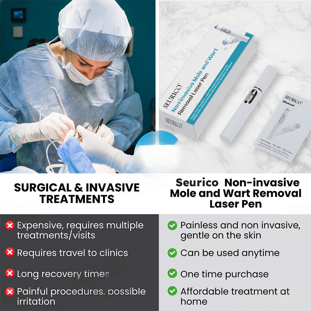 Seurico™ Laser Pen – Non-Invasive Mole and Wart Removal 1–3 days – gentle