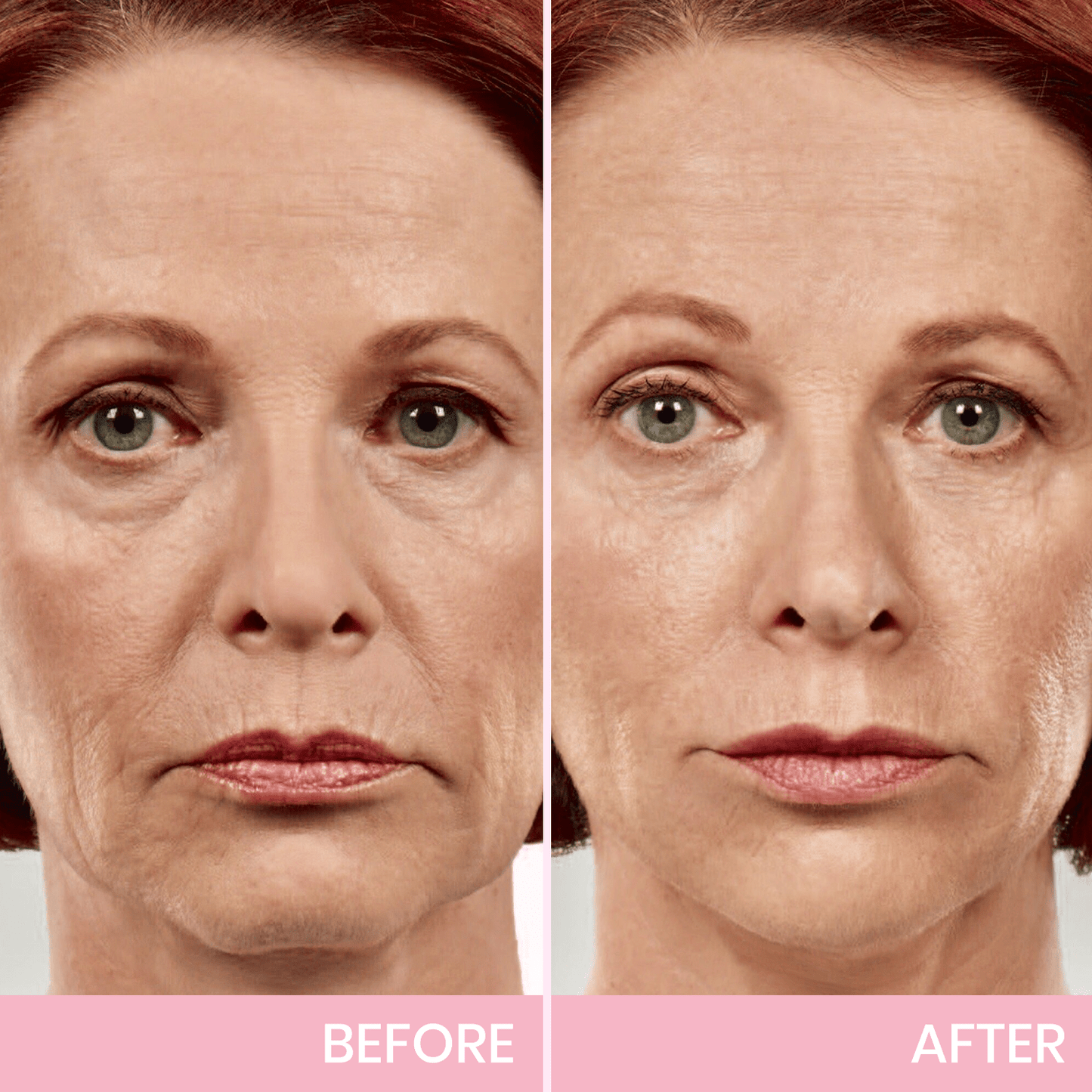 Seurico™ V-Face Lifting Adhesive Tape — Discreet, Waterproof Face Slimming Strips