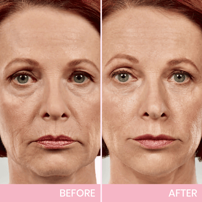 Seurico™ V-Face Lifting Adhesive Tape — Discreet, Waterproof Face Slimming Strips