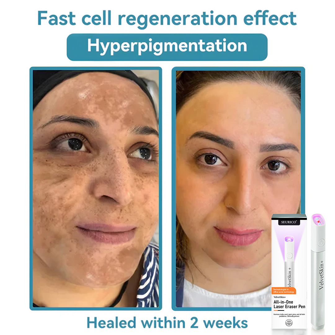 Seurico™ VelvetSkin+ Laser Eraser Pen | Non-Invasive Removal for Moles & Warts