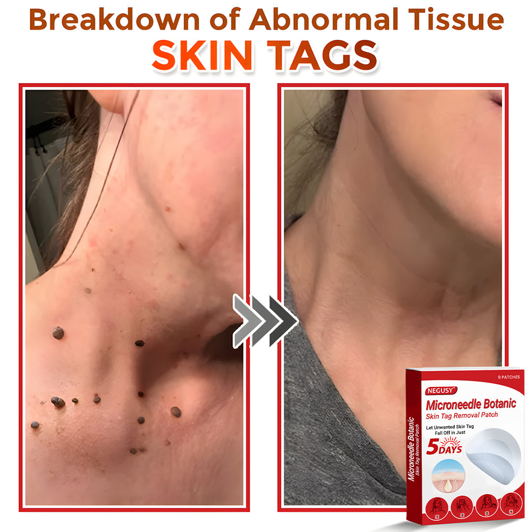 ✅Negusy™ MicroNeedle Botanic Skin Tag Removal Patches – 🇺🇸 Made in the USA | Fast, Painless, Plant-Powered