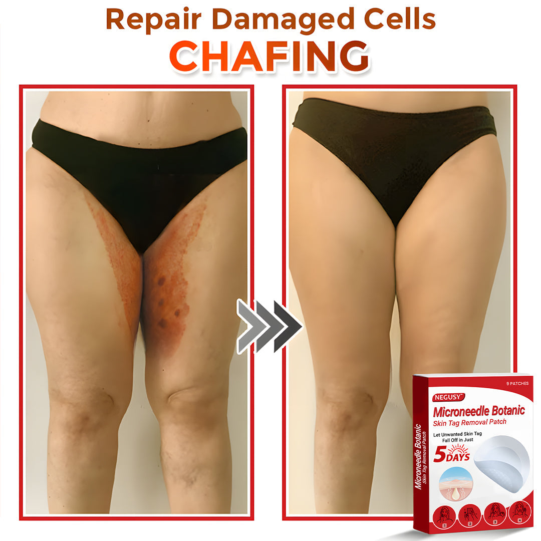 ✅Negusy™ MicroNeedle Botanic Skin Tag Removal Patches – 🇺🇸 Made in the USA | Fast, Painless, Plant-Powered