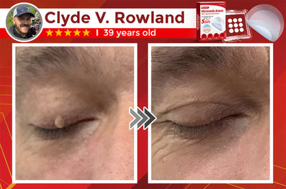 ✅Negusy™ MicroNeedle Botanic Skin Tag Removal Patches – 🇺🇸 Made in the USA | Fast, Painless, Plant-Powered