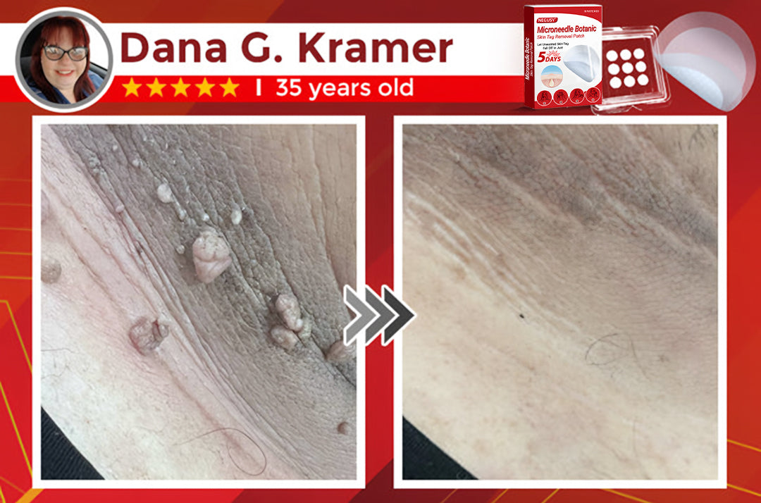 ✅Negusy™ MicroNeedle Botanic Skin Tag Removal Patches – 🇺🇸 Made in the USA | Fast, Painless, Plant-Powered