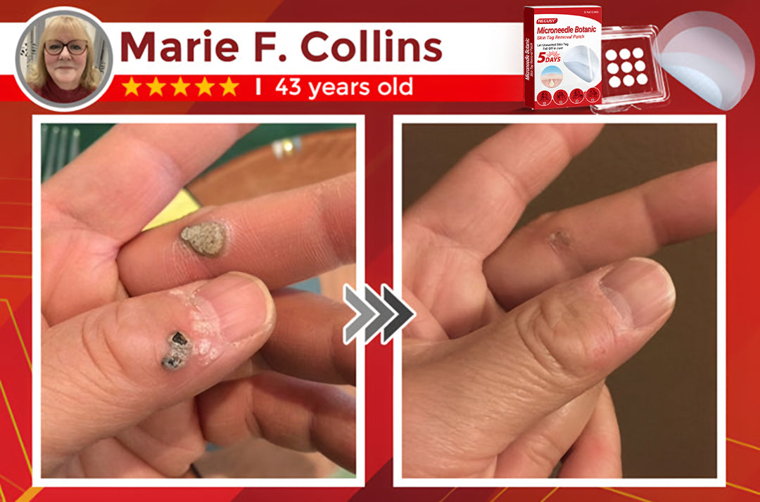 ✅Negusy™ MicroNeedle Botanic Skin Tag Removal Patches – 🇺🇸 Made in the USA | Fast, Painless, Plant-Powered