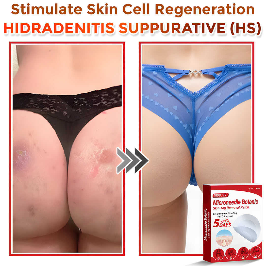 ✅Negusy™ MicroNeedle Botanic Skin Tag Removal Patches – 🇺🇸 Made in the USA | Fast, Painless, Plant-Powered