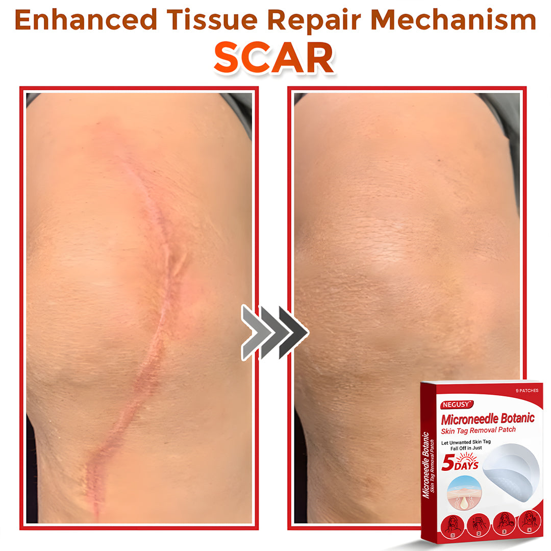 ✅Negusy™ MicroNeedle Botanic Skin Tag Removal Patches – 🇺🇸 Made in the USA | Fast, Painless, Plant-Powered