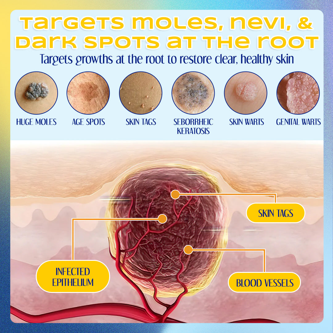 ✨ ODEIUN™ Nevus Removal Cream – Fade Moles & Dark Spots for Clear, Radiant Skin 🌿💧