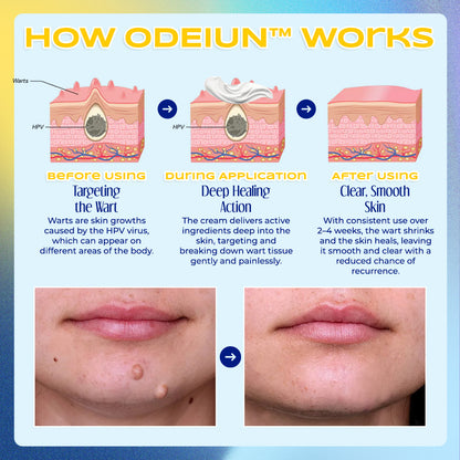 ✨ ODEIUN™ Nevus Removal Cream – Fade Moles & Dark Spots for Clear, Radiant Skin 🌿💧