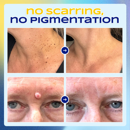✨ ODEIUN™ Nevus Removal Cream – Fade Moles & Dark Spots for Clear, Radiant Skin 🌿💧
