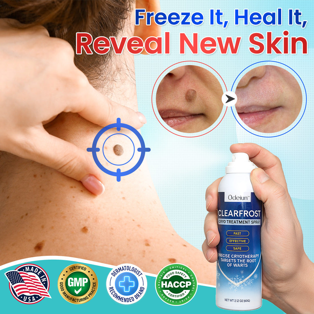 Odeiun™ Clearfrost Cryo Relief Spray🔥 – Advanced Wart & Skin Tag Removal Solution