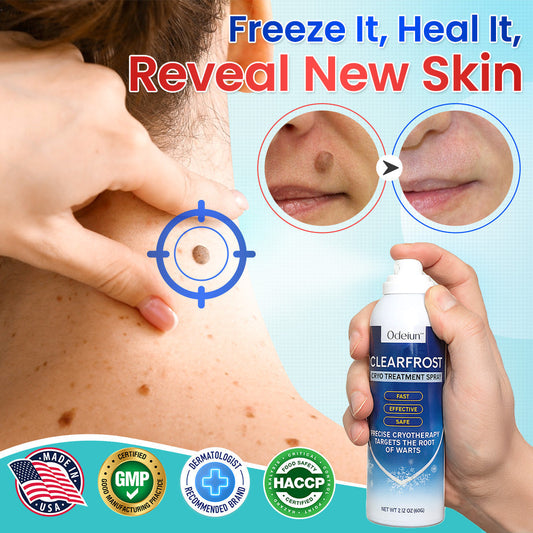 Odeiun™ Clearfrost Cryo Relief Spray🔥 – Advanced Wart & Skin Tag Removal Solution