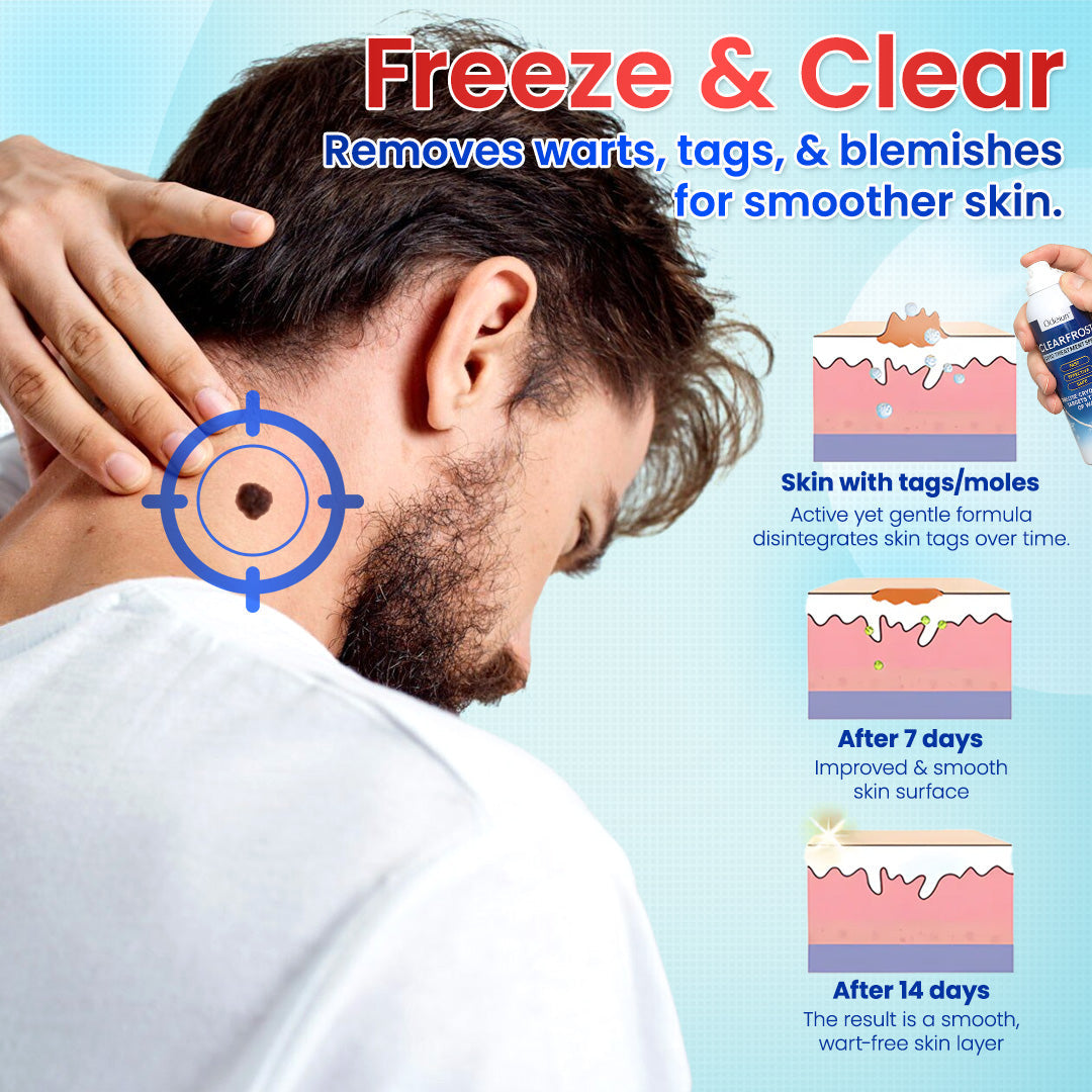 Odeiun™ Clearfrost Cryo Relief Spray🔥 – Advanced Wart & Skin Tag Removal Solution