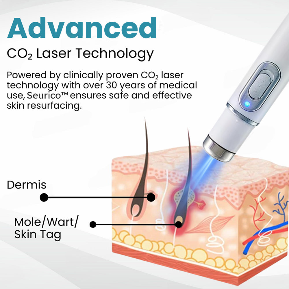 Seurico™ Laser Pen – Non-Invasive Mole and Wart Removal 1–3 days – gentle