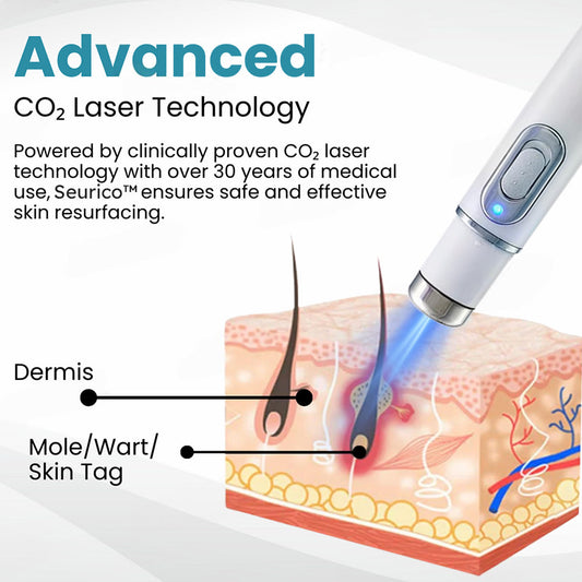 Seurico™ Laser Pen – Non-Invasive Mole and Wart Removal 1–3 days – gentle