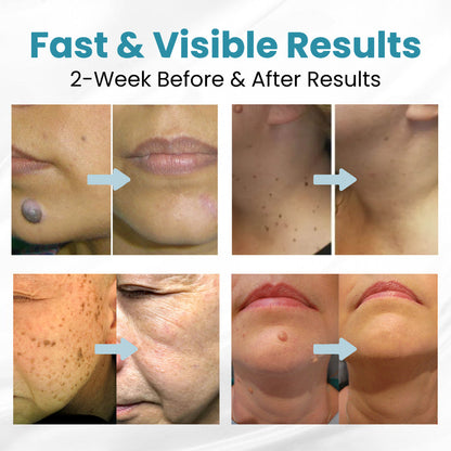 Seurico™ Laser Pen – Non-Invasive Mole and Wart Removal 1–3 days – gentle