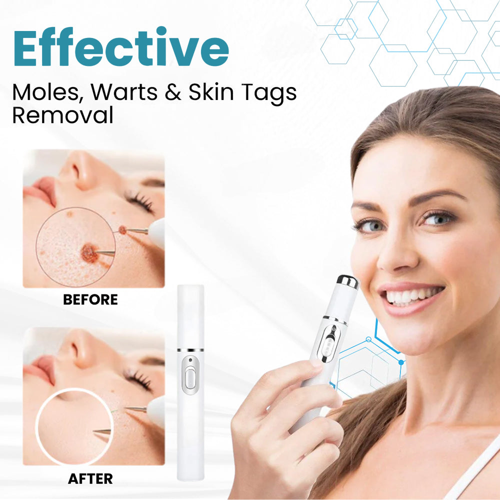 Seurico™ Laser Pen – Non-Invasive Mole and Wart Removal 1–3 days – gentle