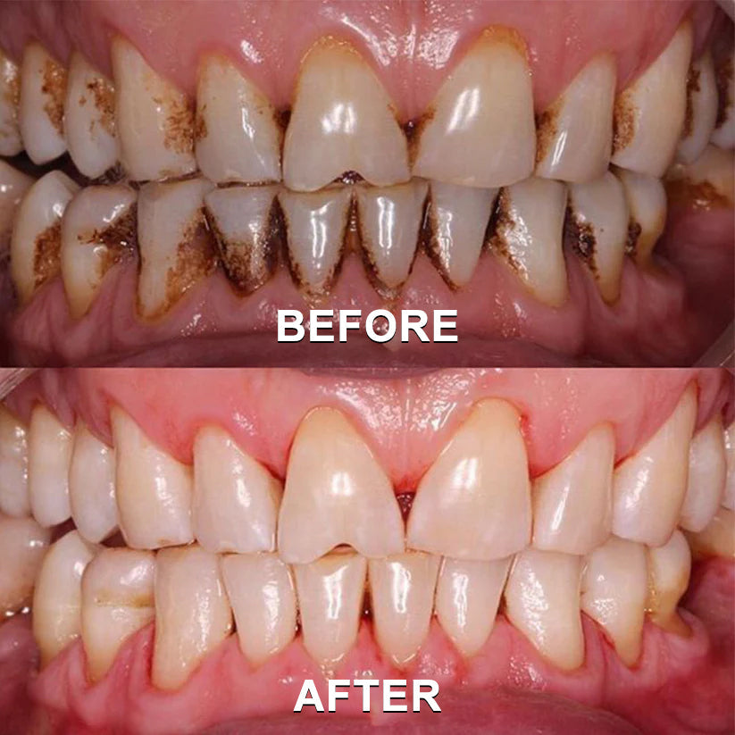 ✅ Seurico™ Gum Repair & Oral Health Powder (CE Certified for Periodontitis, Mouth Sores, and Gum Recession)