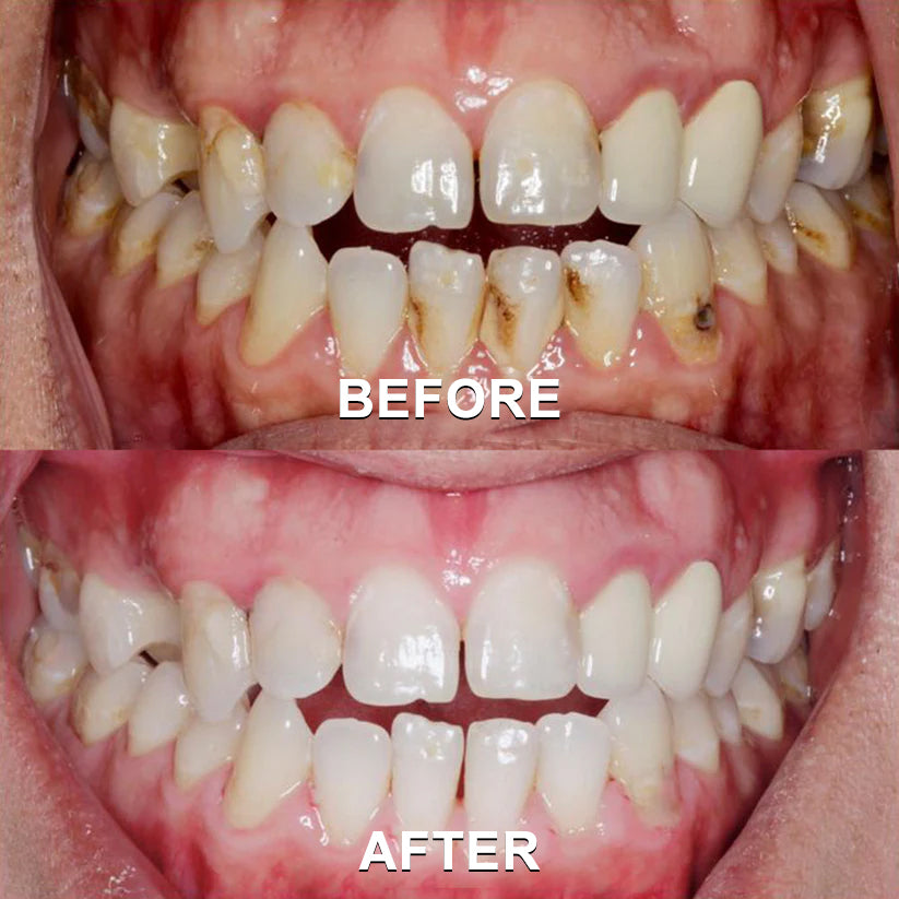 ✅ Seurico™ Gum Repair & Oral Health Powder (CE Certified for Periodontitis, Mouth Sores, and Gum Recession)